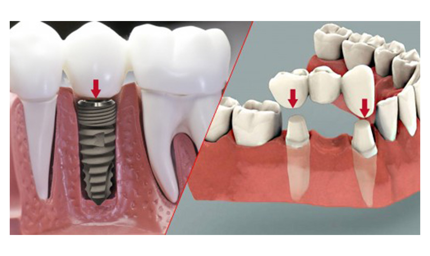 Làm cầu răng với cấy Implant